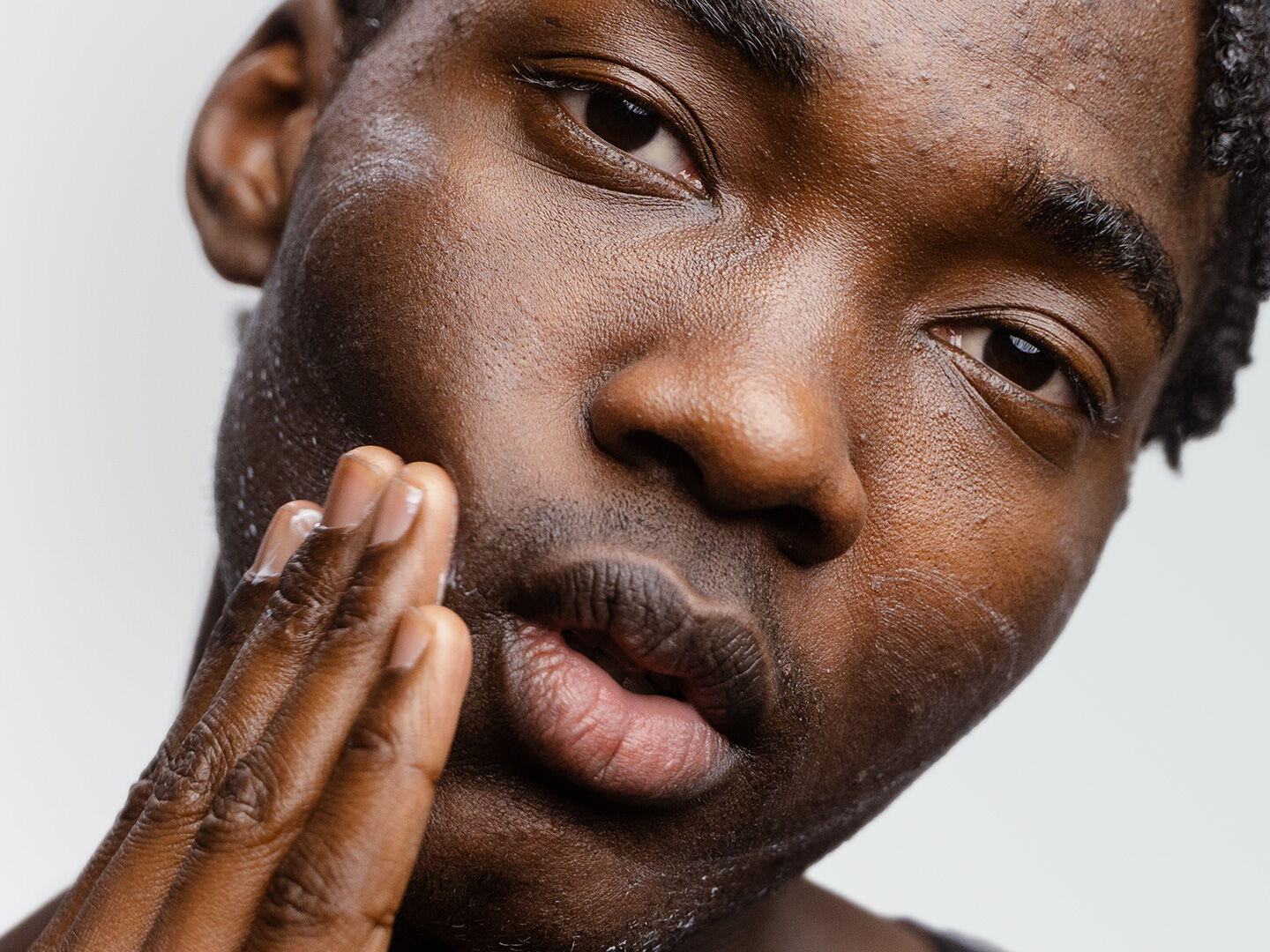 Acne & Blemishes